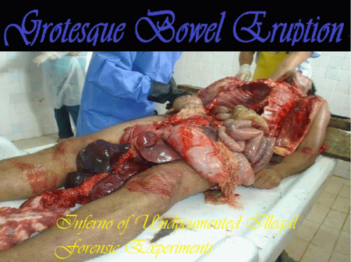 Grotesque Bowel Eruption : Inferno of Undocumented Illegal Forensic Experiments